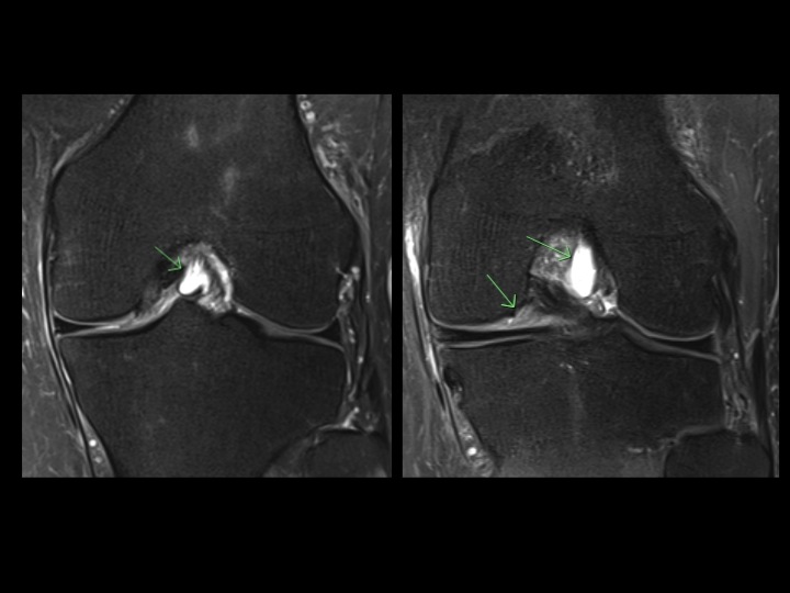 Figure 2 for case anteromedial bundle of anterior cruciate ligament ( RID2782 )